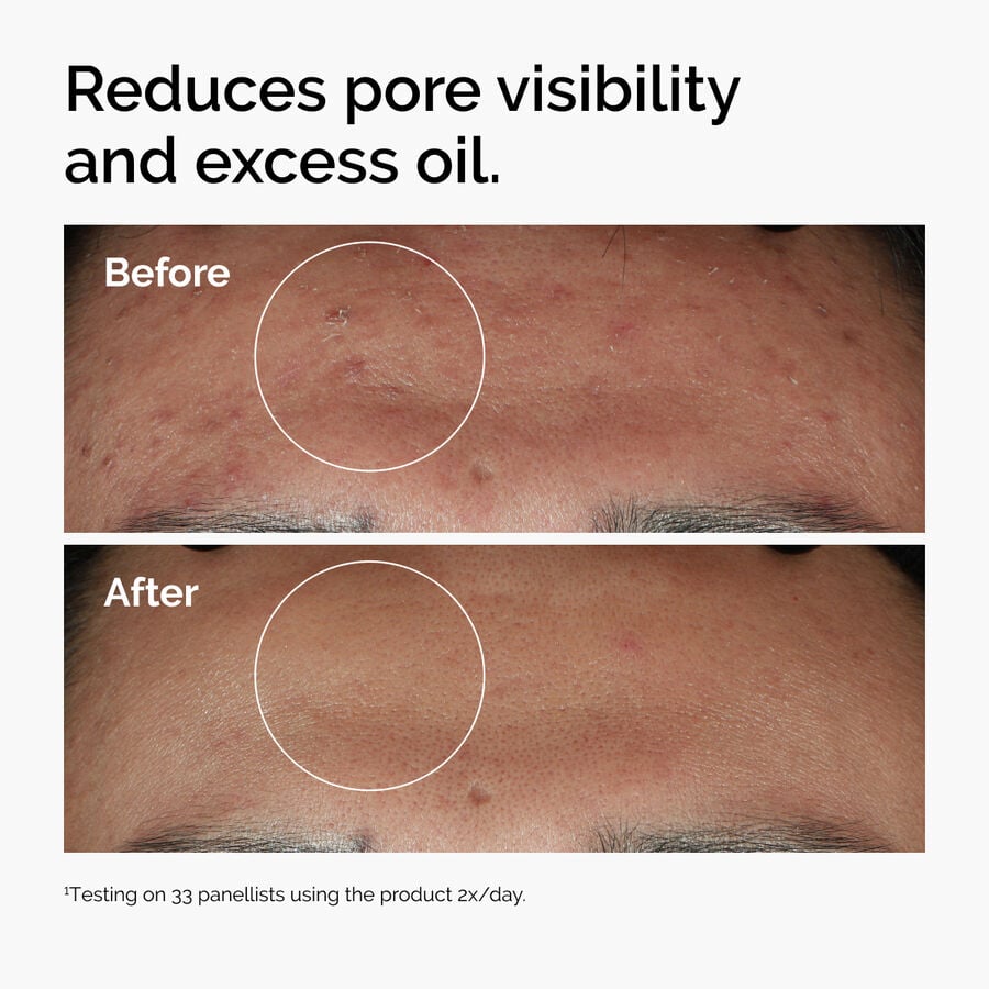 niacinamide-10-zinc-1-b9 ord-niacinamide-zinc-blemish-serum-before-after-pores.jpg
